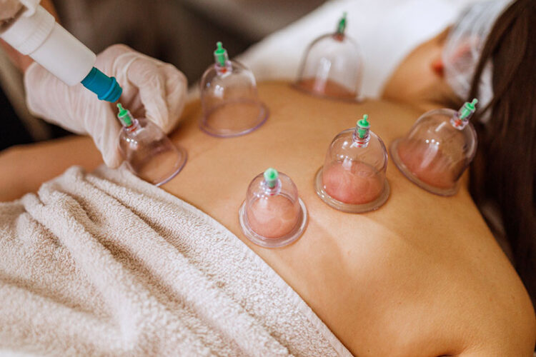 Cupping